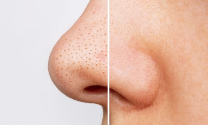 Pore Refinement